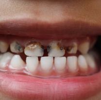 Efecto Milei: Por la crisis los jujeños ya no van al dentista