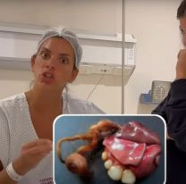 Qué es un teratoma, el tumor con pelos y dientes que le extirparon a Belu Lucius