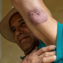 Leishmaniasis en Jujuy: detectaron 11 casos positivos 