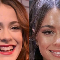 Antes y después de Tini Stoessel contado por su propia cirujana